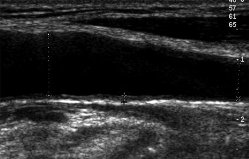 Эхограмма - ремоделирование стенки общей сонной артерии