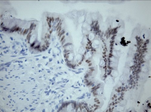 Гистологическое исследование - дупликационная кишечная киста, экспрессия CDX2 в ядрах эпителиальных клеток выстилки кисты