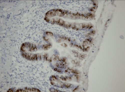 Гистологическое исследование - дупликационная кишечная киста, экспрессия MUC2 в цитоплазме эпителиальных клеток выстилки кисты