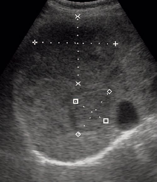 Эхограмма (B-режим) - гигантская кавернозная гемангиома печени