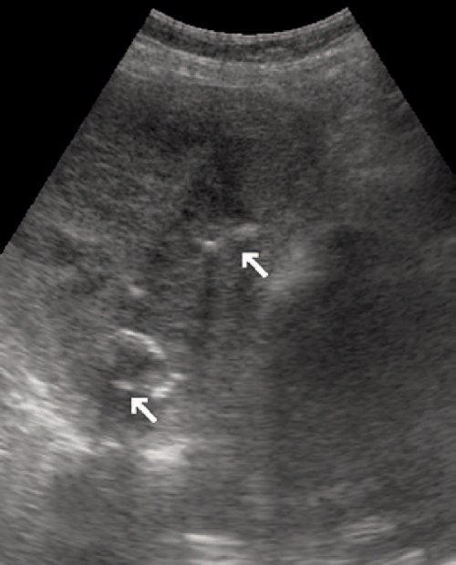 Эхограмма (B-режим) - гигантская кавернозная гемангиома печени с кальцинатами внутри (стрелки)