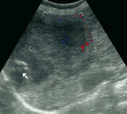 Эхограмма (режим ЦДК) - гигантская кавернозная гемангиома печени, стрелкой обозначены кальцинаты
