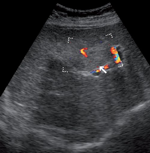 Эхограмма (режим ЦДК) - капиллярная гемангиома печени, вокруг образования визуализируются огибающие сосуды (стрелка)