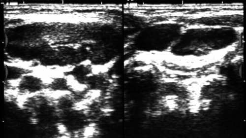 Эхограмма - хроническая реактивная (воспалительная) гиперплазия лимфатического узла шеи