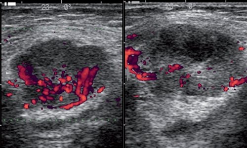 Эхограмма (допплер) - динамика процесса гнойного расплавления лимфатического узла (за 3 дня)