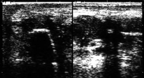 Эхограмма - инородное тело в поднижнечелюстной области (фрагмент пластикового катетера)