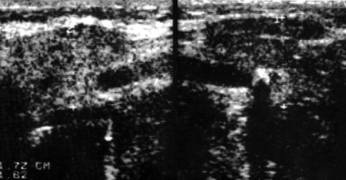 Эхограмма - слюннокаменная болезнь, обызвествленный конкремент в области перегиба выводного протока (типичное место) левой поднижнечелюстной железы, сопутствующий сиаладенит