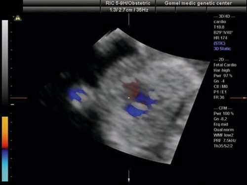 Эхограмма (режим STIC) - транспозиция магистральных сосудов, виден параллельный ход выносящих сосудов, верхний из которых выходит из левого желудочка и делится на бифуркацию (легочная артерия), беременность 13 недель