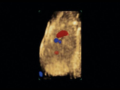 Эхограмма (режим STIC) - общий артериальный ствол, виден единый выносящий сосуд из двух желудочков, беременность 12 недель