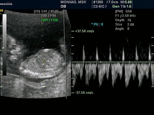 Эхограмма - реверсный кровоток в венозном протоке у плода с гетеротаксией, беременность 12 недель