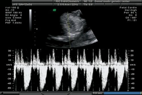 Эхограмма - трикуспидальная регургитация у плода с общим артериальным стволом, беременность 12 недель