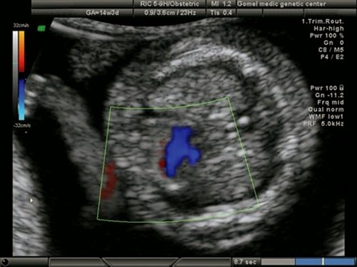 Эхограмма - синдром гипоплазии левых отделов сердца у плода с синдромом Тернера (45Х), единый поток через трикуспидальный клапан, сброс крови в гипоплазированный левый желудочек через ДМЖП, беременность 13 недель