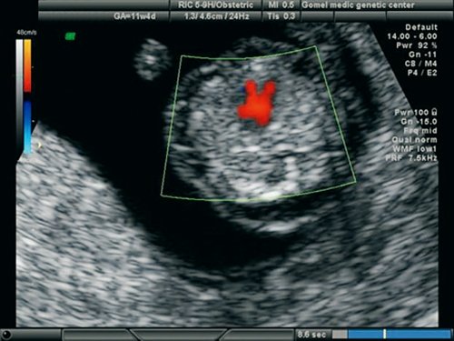 Эхограмма (режим ЦДК) - 4-х камерный срез сердца, единый атриовентрикулярный клапан, беременность 11,4 недель
