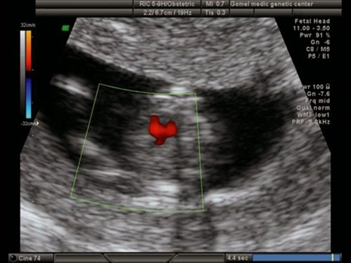 Эхограмма (режим ЦДК) - обширный ДМЖП у плода с синдромом Эдвардса (трисомия 18), беременность 12 недель