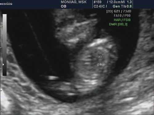 Эхограмма - срез сердца плода через три сосуда, визуализируются аорта и легочной ствол, сосуды расположены в одну линию и имеют нормальные размеры, беременность 12 недель