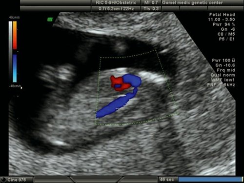 Эхограмма (режим ЦДК) - срез через дугу аорты, сужение аорты в типичном месте у плода с синдромом Тернера (45Х), беременность 12 недель