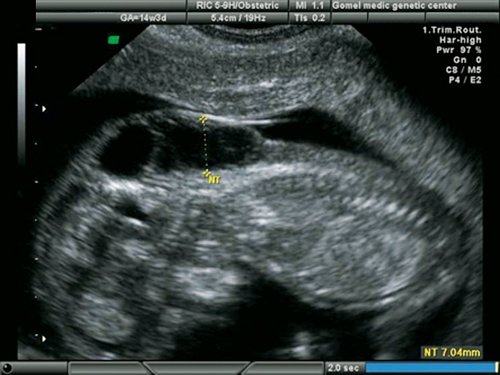 Эхограмма - увеличенная ТВП у плода с гипоплазией левых отделов сердца, беременность 13 недель