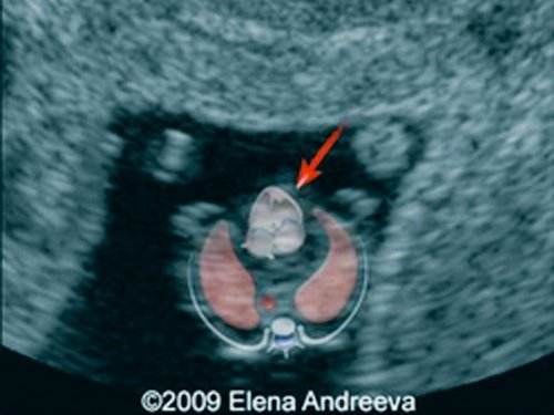 Эхограмма - эктопия сердца, сердце расположено снаружи грудной полости, беременность 8 недель (б)