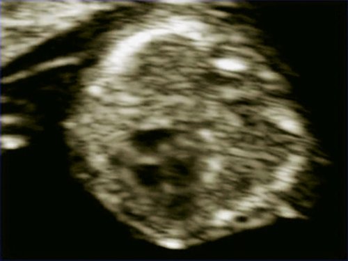 Эхограмма - 4-х камерный срез сердца плода, отчетливо видны камеры сердца, положение атриовентрикулярных клапанов, беременность 13 недель