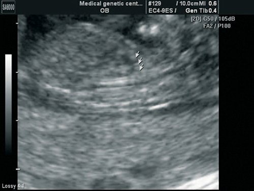 Эхограмма - срез сердца плода через дугу аорты, отчетливо видны три плечеголовных сосуда, отходящих от дуги, беременность 13 недель