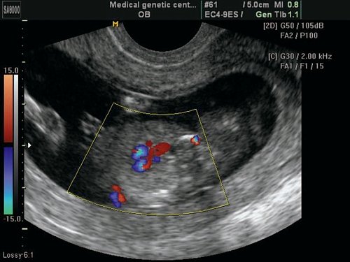 Эхограмма (режим ЦДК) - тетрада Фалло, срез через выносящий тракт левого желудочка, видна аорта-наездница, сидящая над ДМЖП, беременность 12 недель
