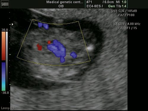 Эхограмма (режим ЦДК) - двойной выход сосудов из правого желудочка, параллельный выход сосудов из правого желудочка, беременность 13 недель