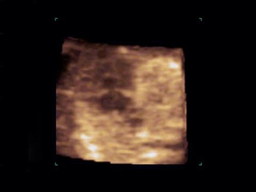 Эхограмма (режим STIC) - атриовентрикулярная коммуникация (АВК) при синдроме Дауна, беременность 12 недель