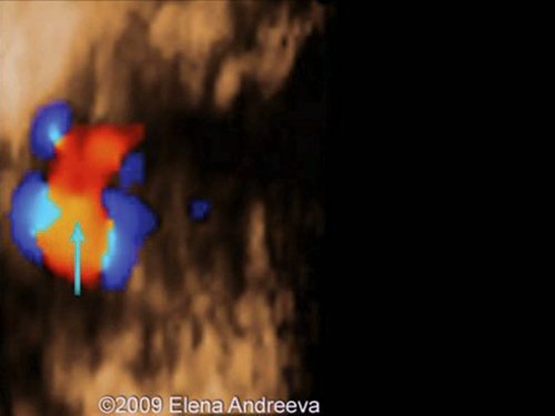 Эхограмма (режим STIC) - Тетрада Фалло, аорта-наездница, сидящая над ДМЖП, беременность 12 недель