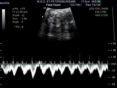 Эхограмма (режим импульсного допплера) - оценка характера кровотока в исследуемом сосуде, спектр кровотока двухфазный, типичный для вен, располагающихся близко к сердцу