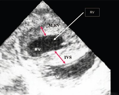 Эхограмма - систолическая перегрузка правого желудочка, поперечное сечение желудочков сердца при стенозе легочной артерии, выраженная гипертрофия межжелудочковой перегородки (IVS) и миокарда передней стенки правого желудочка (MRV), RV - правый желудочек