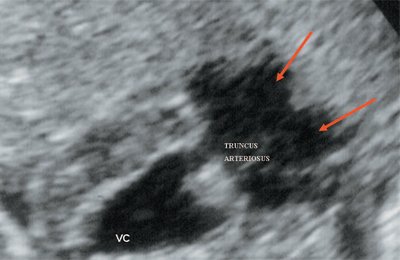Эхограмма - общий желудочек с отхождением TRUNCUS ARTERIOSUS, стрелками показано разделение TRUNCUS ARTERIOSUS на аорту и ствол легочной артерии (VC - общий желудочек, TRUNCUS ARTERIOSUS - общий артериальный ствол)