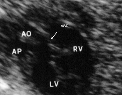 Эхограмма - двойное отхождение магистральных сосудов от левого желудочка, магистральные сосуды инвертированы и отходят от левого желудочка ). Аорта расположена ''верхом'' над дефектом межжелудочковой перегородки - стрелка (LV и RV - левый и правый желудочек, АР - легочная артерия, АО - аорта, VSD - дефект межжелудочковой перегородки)