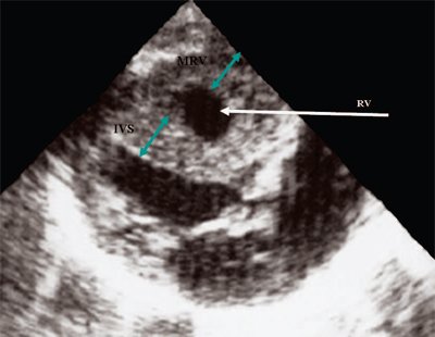 Эхограмма - стеноз легочной артерии, гипертрофия миокарда правого желудочка (RV - правый желудочек, IVS - межжелудочковая перегородка, MRV - миокард правого желудочка)