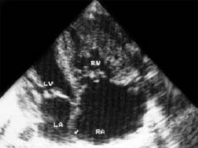 Эхограмма - выраженный стеноз легочной артерии, значительное увеличение полости правого предсердия (LV и RV - левый и правый желудочек, LA и RA - левое и правое предсердие)