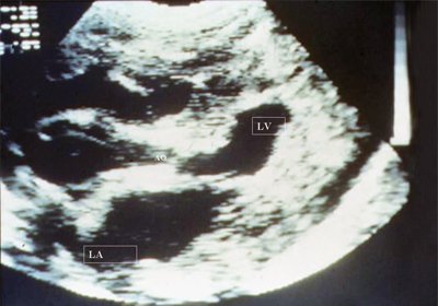 Эхограмма - стеноз аорты, отмечаются выраженное сужение аортального отверстия, выраженная гипертрофия миокарда левого желудочка, уменьшение его полости и дилатация левого предсердия (LV - левый желудочек, LA - левое предсердие, АО - аорта)