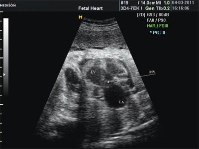 Эхограмма - преждевременное закрытие клапана овального окна, отмечаются умеренная гипоплазия левого желудочка, значительное увеличение левого предсердия, стрелкой показано митральное отверстие (LV - левый желудочек, LA - левое предсердие, MV - митральный клапан)