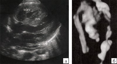 Коарктация аорты. MRV - правый желудочек, IVS - межжелудочковая перегородка