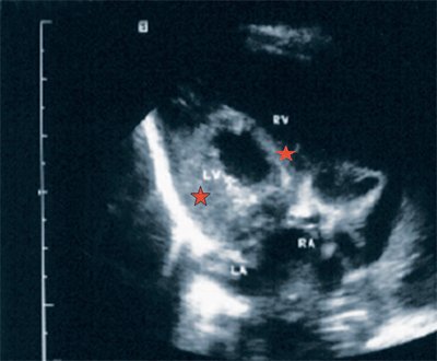 Эхограмма - синдром Стейделя, имеется выраженная гипертрофия миокарда левого желудочка и межжелудочковой перегородки, полости правого желудочка и правого предсердия значительно увеличены в размерах (LV и RV - левый и правый желудочек, LA и RA - левое и правое предсердие)