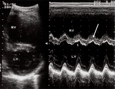 Эхограмма (В- и М-режим) - объемная перегрузка правого желудочка при дефекте межпредсердной перегородки, стрелкой показан парадоксальный характер движения межжелудочковой перегородки (LV и RV - левый и правый желудочек)