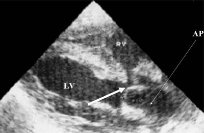 Эхограмма - синдром Тауссиг - Бинга, легочная артерия (отмечена стрелкой) расположена над дефектом межжелудочковой перегородки (АР - легочная артерия, LV и RV - левый и правый желудочек