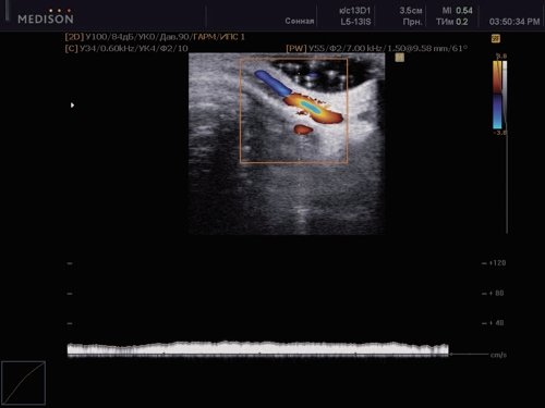 Эхограмма - гипоплазия внутренней яремной вены у больного с венозной недостаточностью