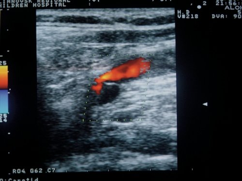Эхограмма - кровоток по внутренней яремной вене у больного с венозной недостаточностью при проведении пробы Вальсальвы