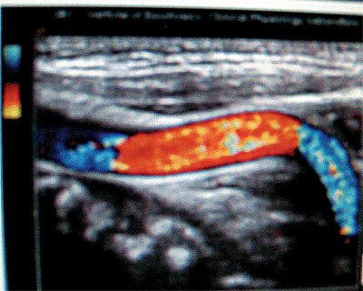 Эхограмма (режим ЦДС) - С-образная извитость внутренней сонной артерии (ВСА)