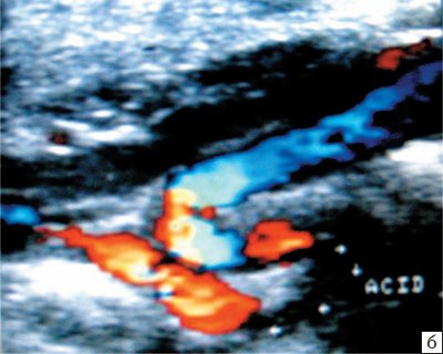 Эхограмма (режим ЦДС) - S-образная патологическая извитость ВСА (б)