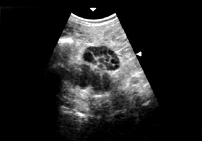 Эхограмма сложного кистозного образования правой почки - эхонегативное многокамерное образование неправильной формы, с неровными стенками. Большое количество тонких перегородок в полости образования