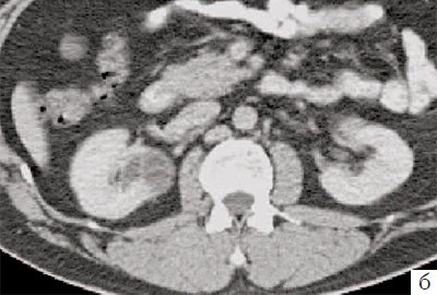 КТ - кистозное образование правой почки, после контрастирования отчетливо выявляются плотная стенка и множество перегородок