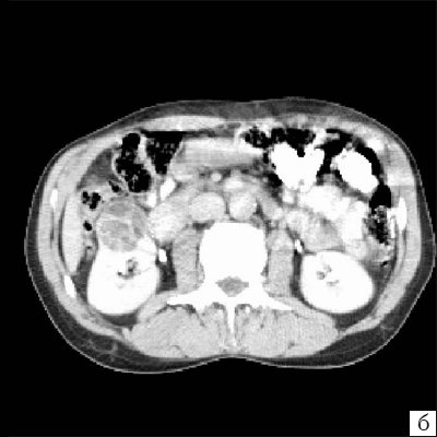 КТ - кистозное образование правой почки, после контрастирования (паренхиматозная фаза) отчетливо выявляются плотная стенка и множество перегородок