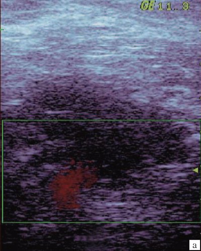 Эхограмма антрального отдела желудка (продольная проекция, режим ЦДК) после коррекции дуоденогастрального рефлюкса: прокрашивание внутрипросветного потока соответствует антеградному направлению