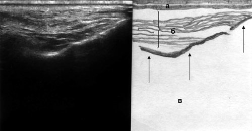 Эхографическая картина верхнечелюстной пазухи (норма), сагиттальный срез: а - кожа, б - мягкие ткани, в - воздух, тонкие стрелки - передняя стенка пазухи