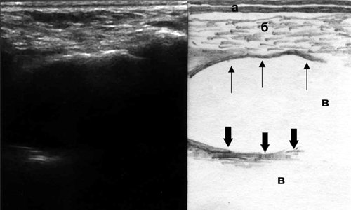 Эхографическая картина кисты верхнечелюстной пазухи, горизонтальный срез (а - кожа, б - мягкие ткани, в - воздух, тонкие стрелки - передняя стенка кисты, толстые стрелки - задняя стенка кисты